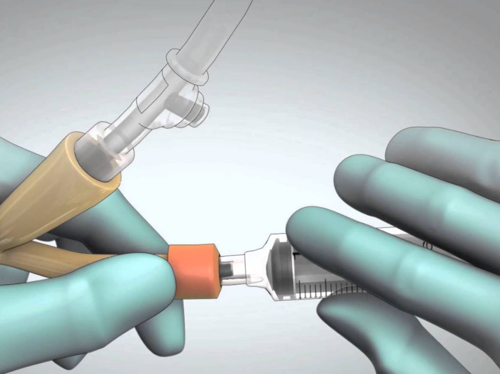 How To Remove a Catheter